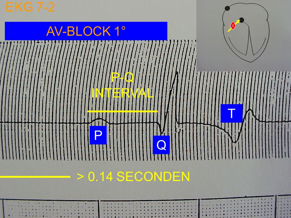 EKG 7-2 AV-BLOCK 1° P-Q INTERVAL T P Q > 0.14 SECONDEN