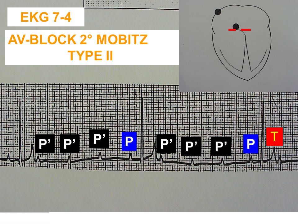 EKG 7-4 AV-BLOCK 2° MOBITZ TYPE II T P’ P P’ P’ P’ P P’ P’