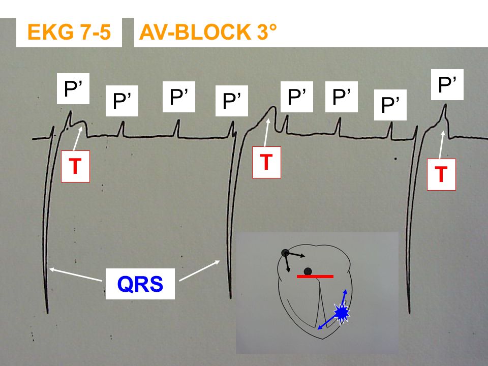EKG 7-5 AV-BLOCK 3° P’ P’ P’ P’ P’ P’ P’ P’ T T T QRS