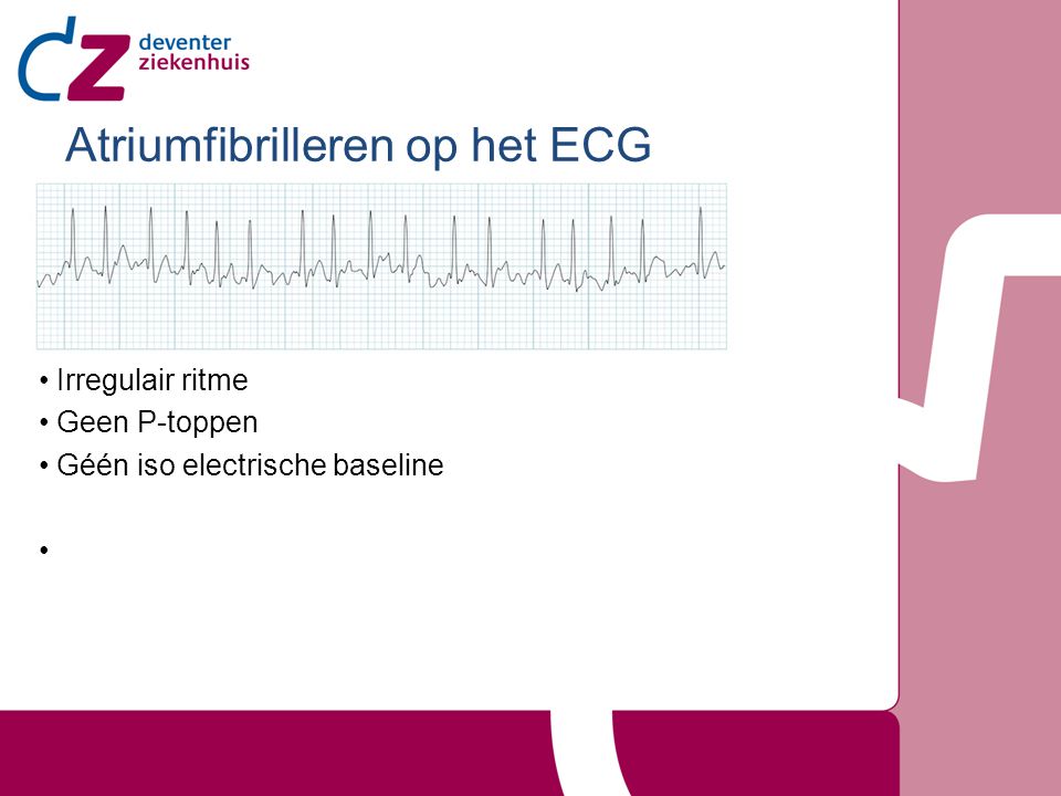 Atriumfibrilleren op het ECG