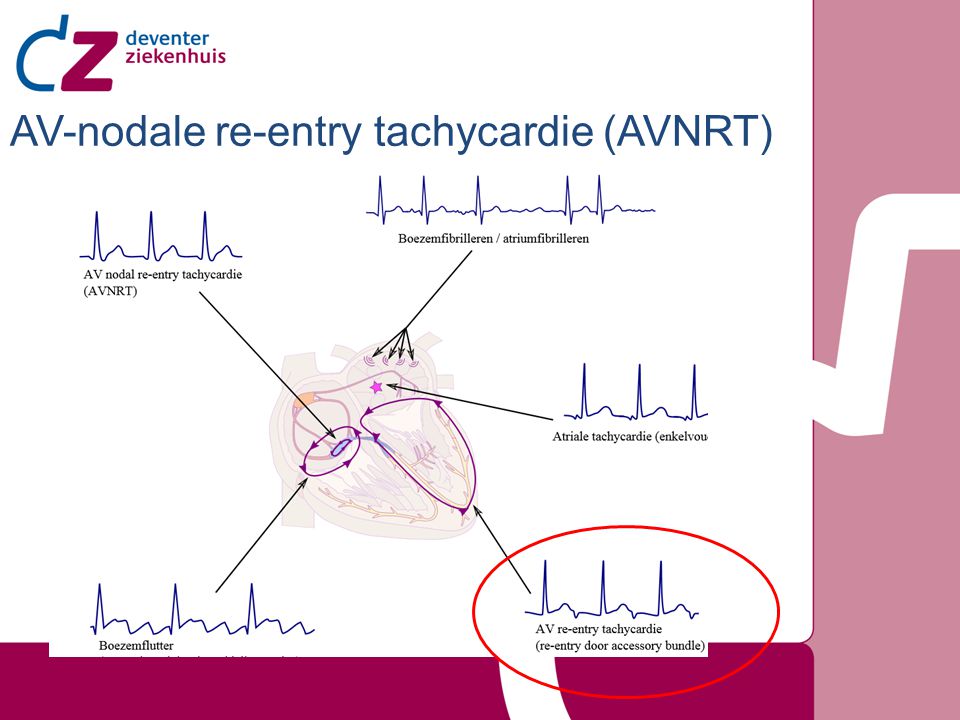 AV-nodale re-entry tachycardie (AVNRT)