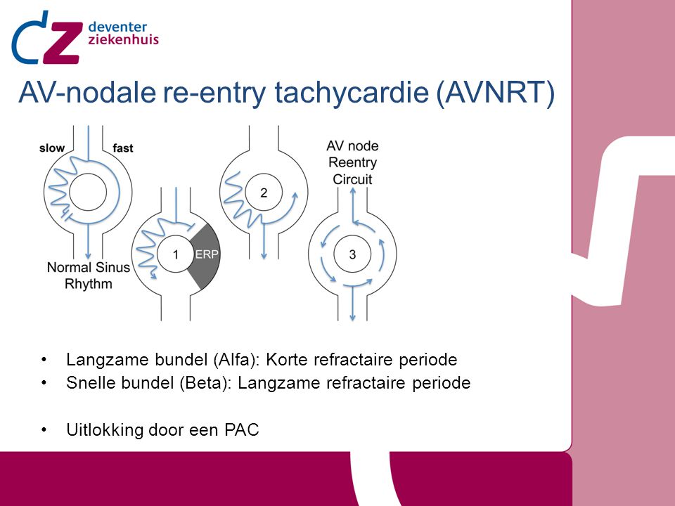AV-nodale re-entry tachycardie (AVNRT)