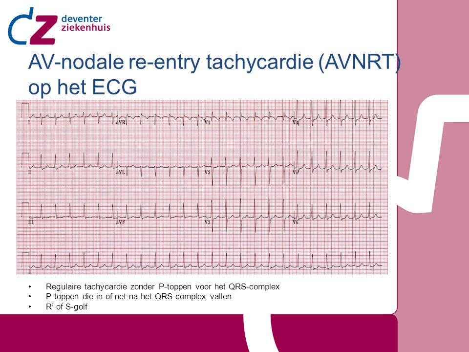 AV-nodale re-entry tachycardie (AVNRT) op het ECG