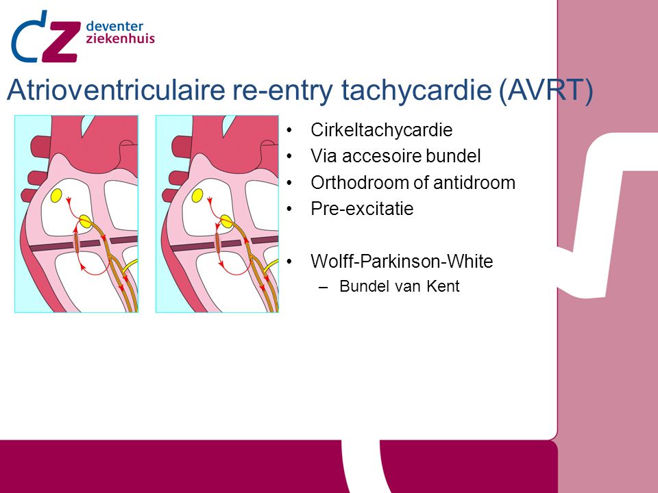 Atrioventriculaire re-entry tachycardie (AVRT)