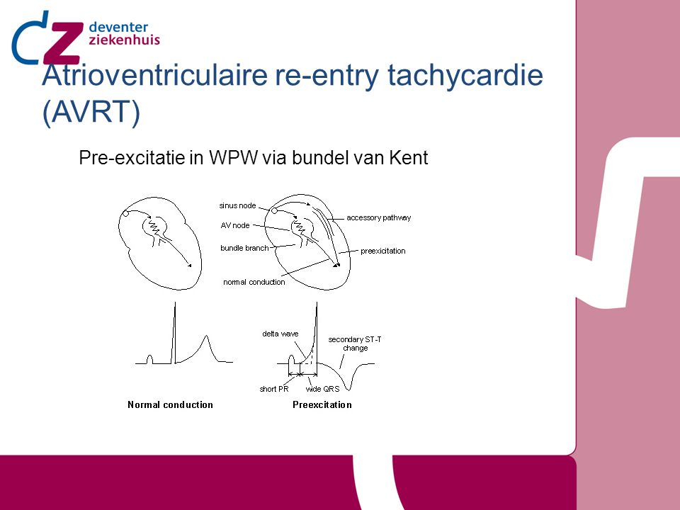 Atrioventriculaire re-entry tachycardie (AVRT)