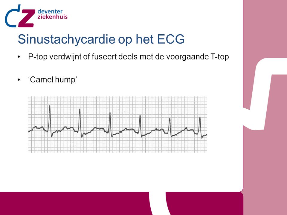 Sinustachycardie op het ECG