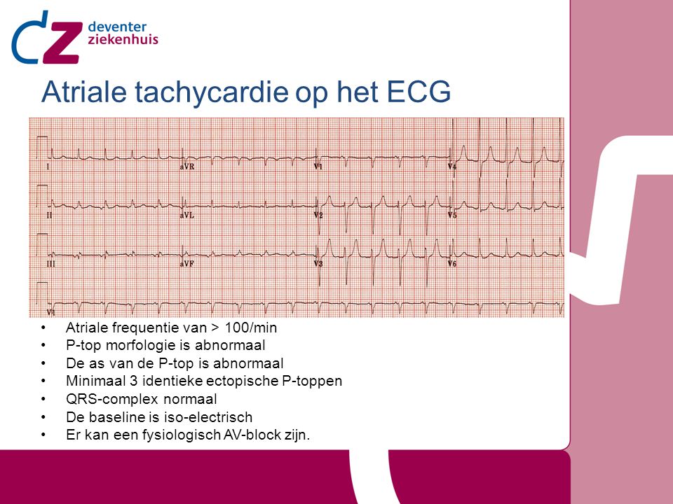 Atriale tachycardie op het ECG
