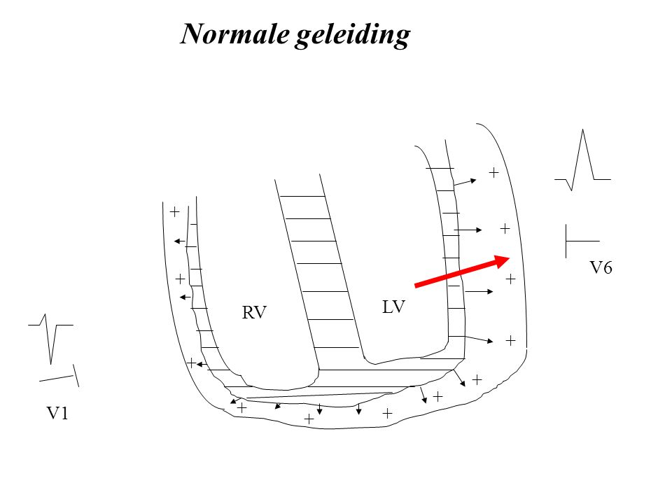 Normale geleiding V6 + + LV RV V1 + +