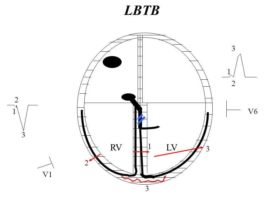 LBTB V6 3 RV 1 LV 3 2 V1 3
