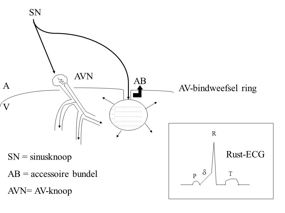 SN AVN AB A AV-bindweefsel ring V Rust-ECG SN = sinusknoop