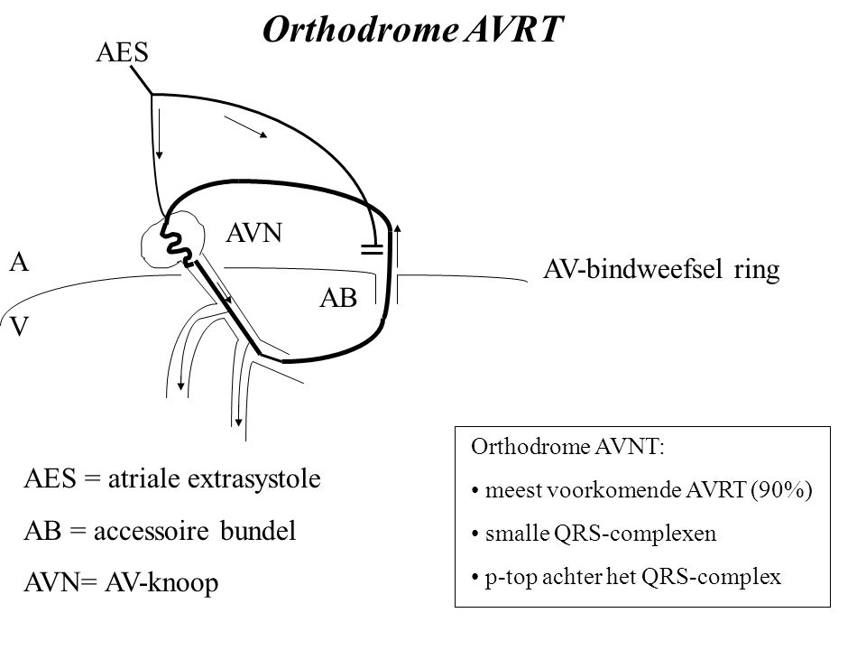 Orthodrome AVRT AES AVN A AV-bindweefsel ring AB V