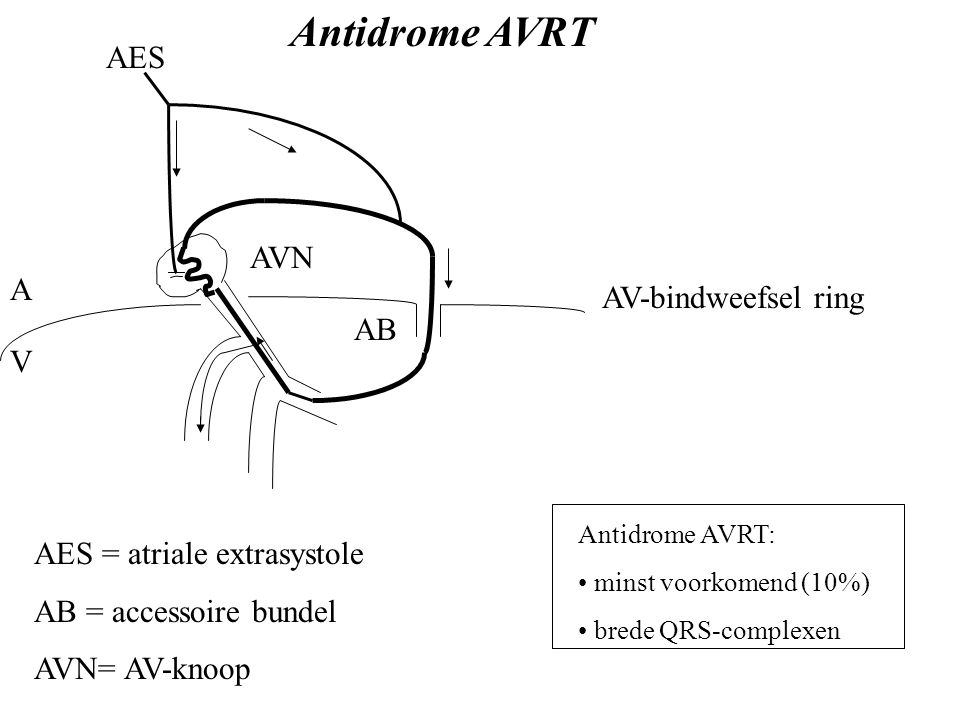 Antidrome AVRT AES AVN A AV-bindweefsel ring AB V