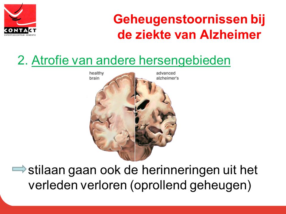 Geheugenstoornissen bij de ziekte van Alzheimer