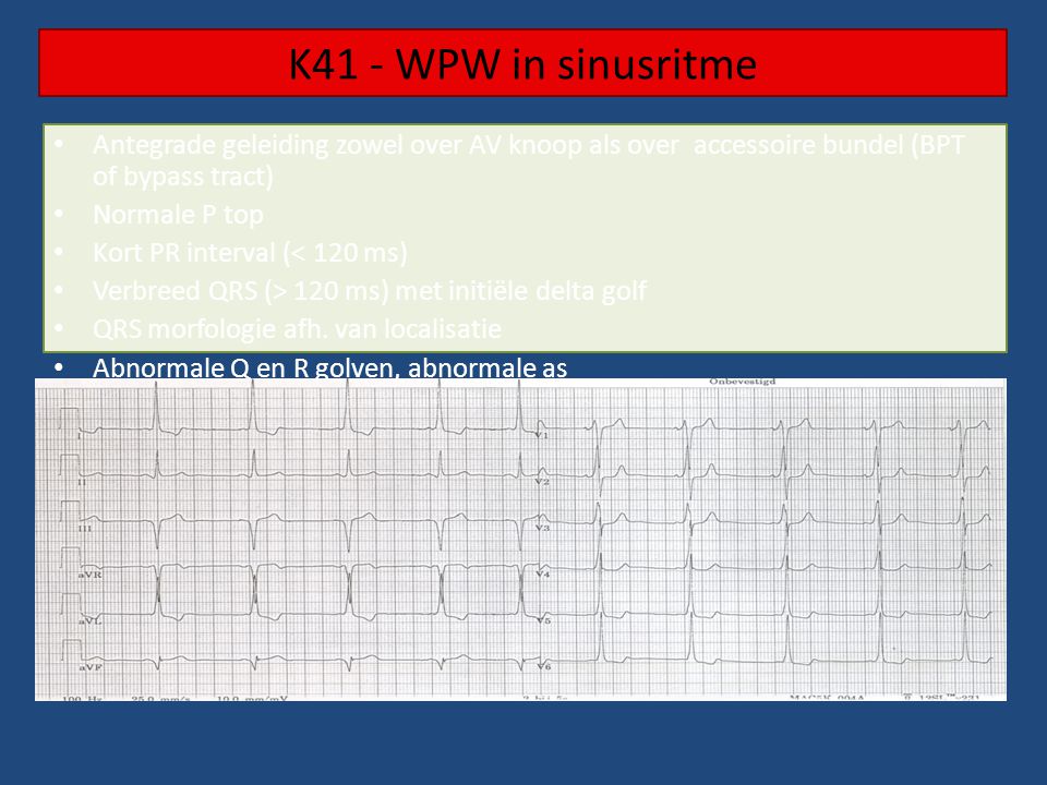 K41 - WPW in sinusritme Antegrade geleiding zowel over AV knoop als over accessoire bundel (BPT of bypass tract)