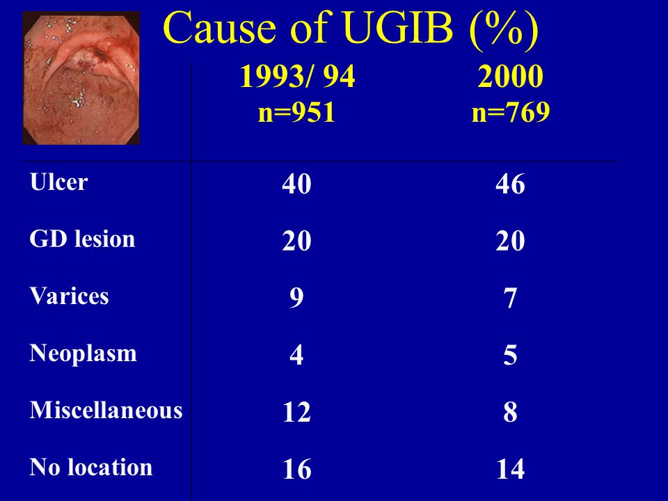 Cause of UGIB (%) 1993/ 94. n= n=769. Ulcer GD lesion. 20. Varices. 9.