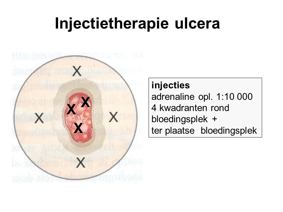 Injectietherapie ulcera