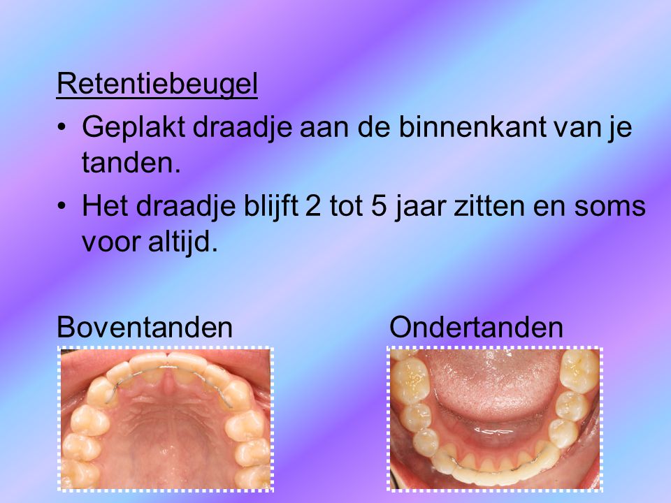 Retentiebeugel Geplakt draadje aan de binnenkant van je tanden. Het draadje blijft 2 tot 5 jaar zitten en soms voor altijd.