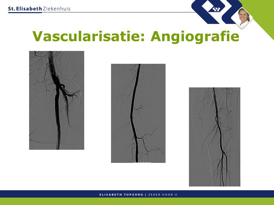 Vascularisatie: Angiografie