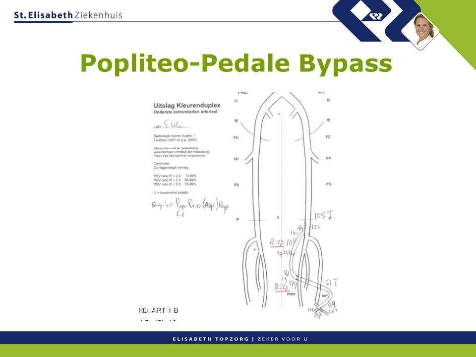 Popliteo-Pedale Bypass