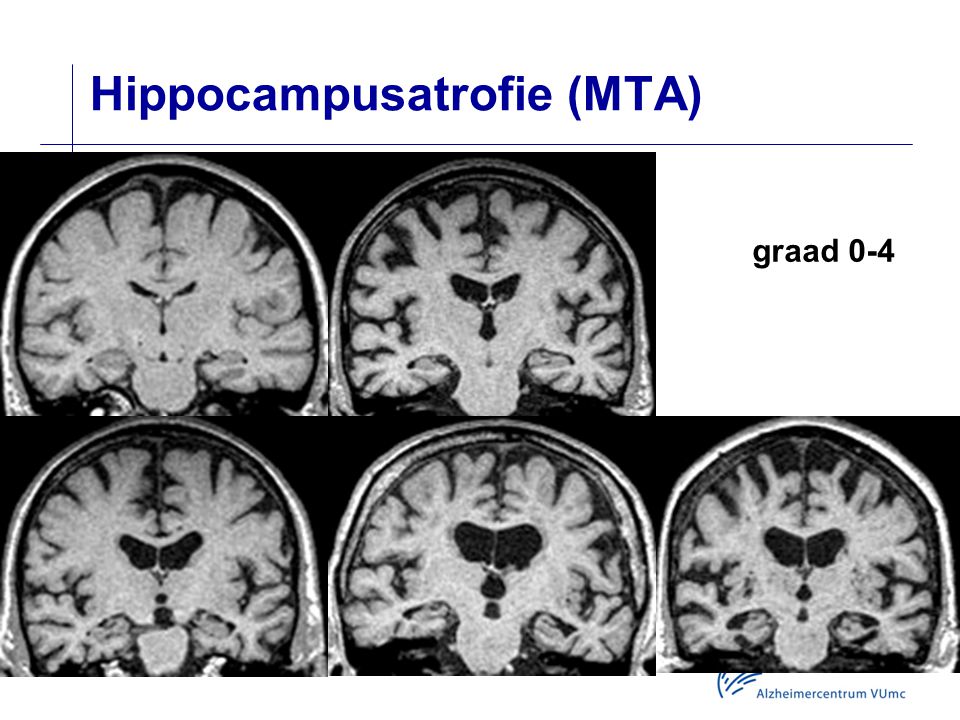 Hippocampusatrofie (MTA)