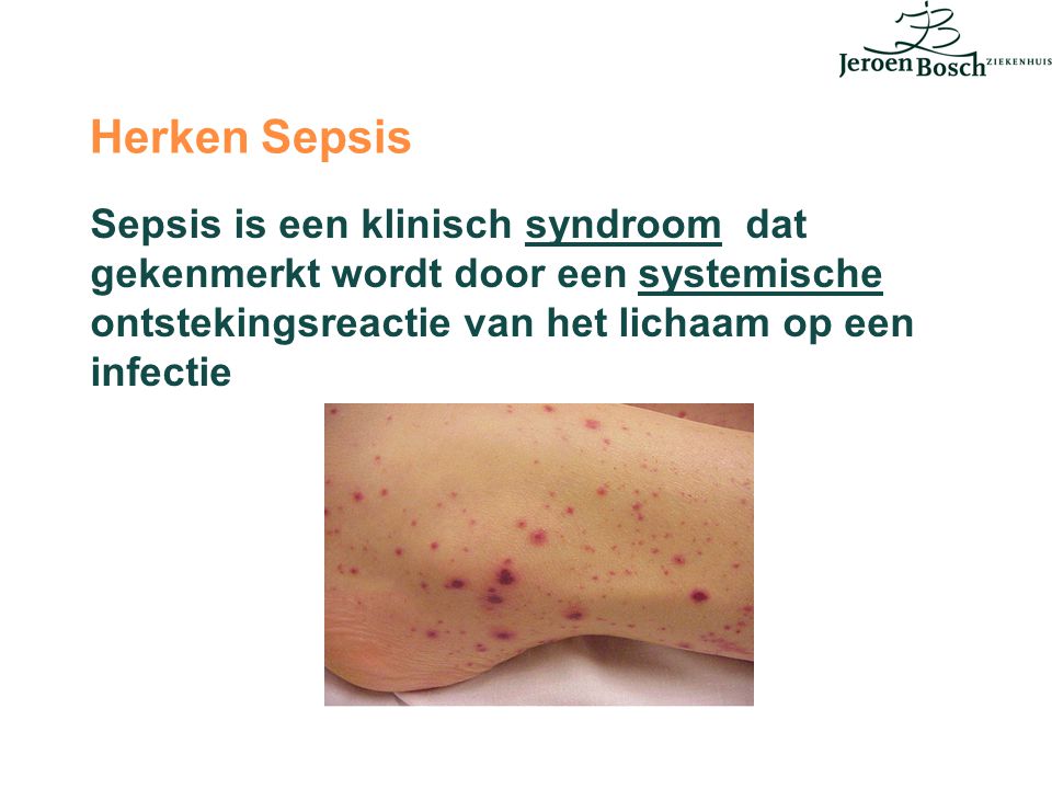 Herken Sepsis Sepsis is een klinisch syndroom dat gekenmerkt wordt door een systemische ontstekingsreactie van het lichaam op een infectie.