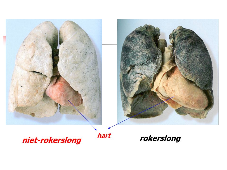 hart rokerslong niet-rokerslong