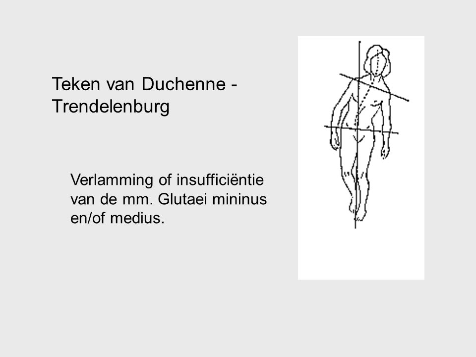 Teken van Duchenne - Trendelenburg