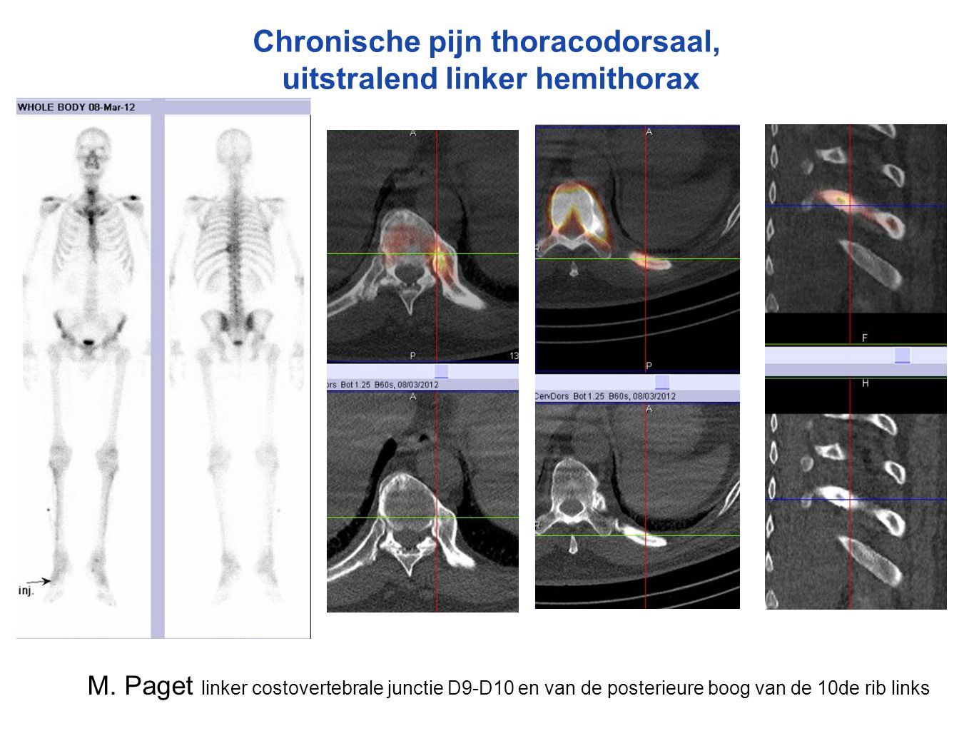 Chronische pijn thoracodorsaal, uitstralend linker hemithorax