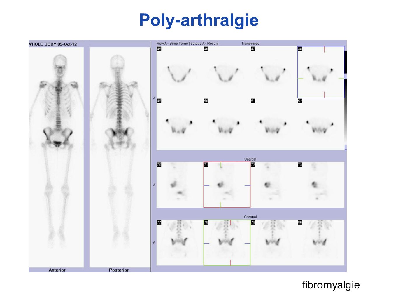 Poly-arthralgie fibromyalgie
