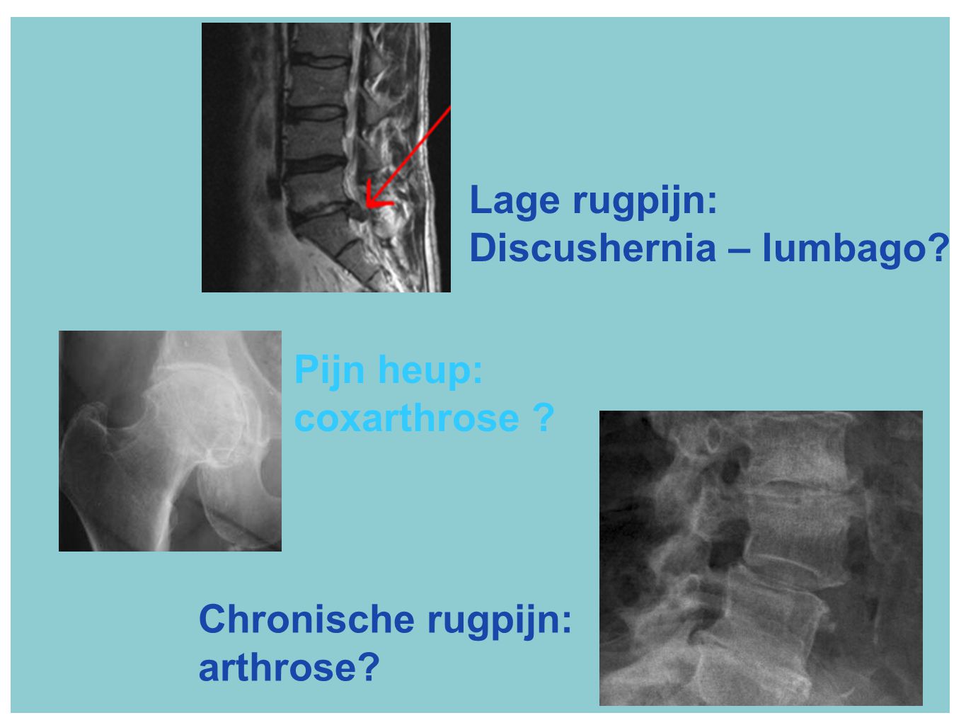 Lage rugpijn: Discushernia – lumbago Pijn heup: coxarthrose Chronische rugpijn: arthrose