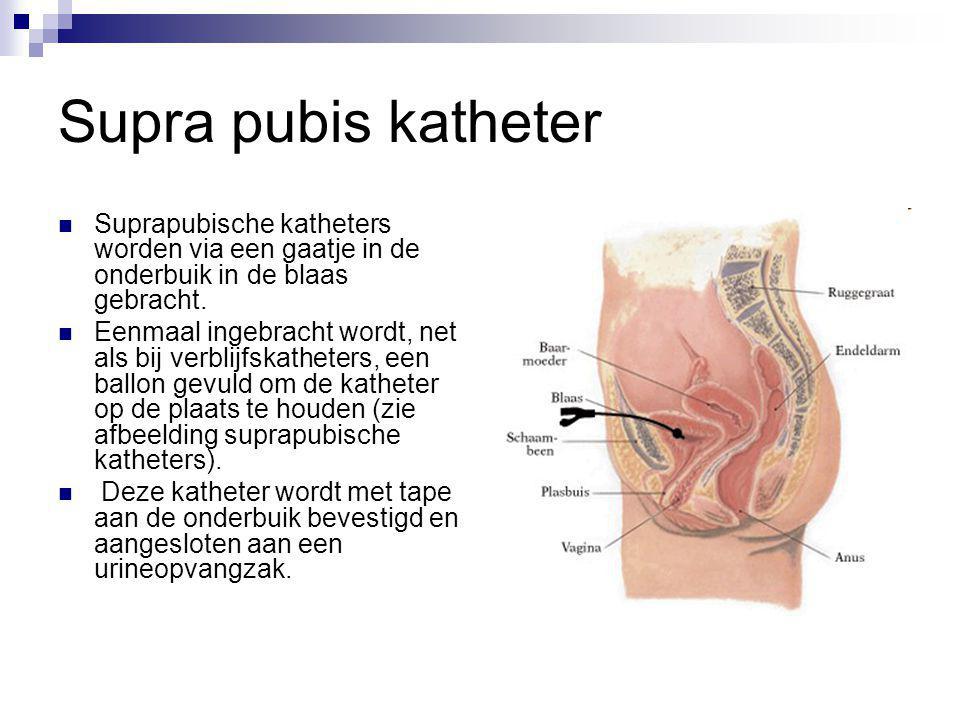 Supra pubis katheter Suprapubische katheters worden via een gaatje in de onderbuik in de blaas gebracht.