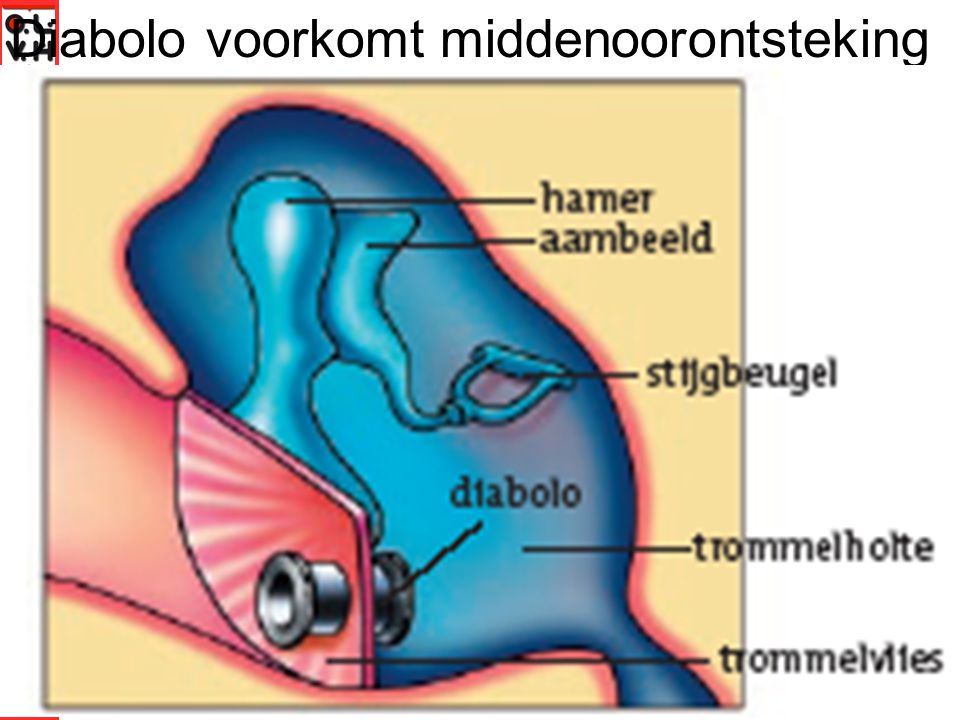 Diabolo voorkomt middenoorontsteking
