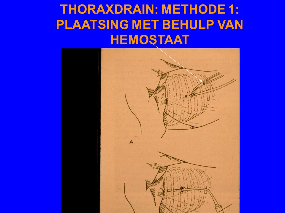 THORAXDRAIN: METHODE 1: PLAATSING MET BEHULP VAN HEMOSTAAT