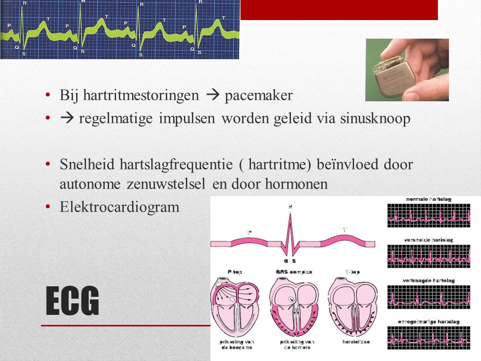 ECG Bij hartritmestoringen  pacemaker