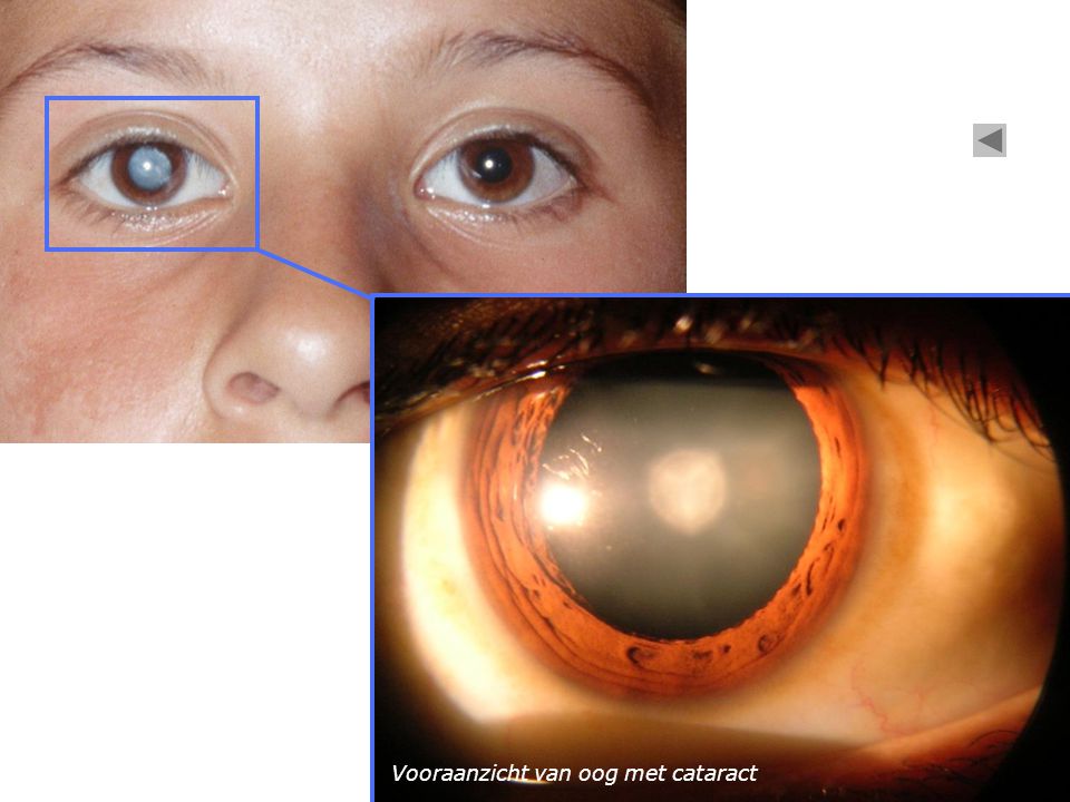 Vooraanzicht van oog met cataract