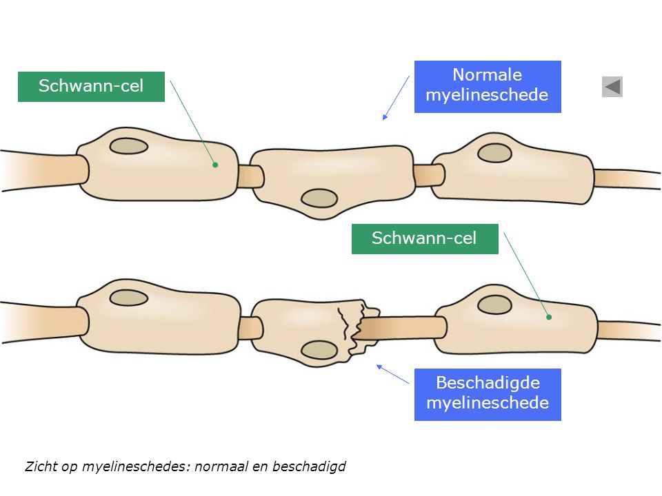 Normale myelineschede Schwann-cel