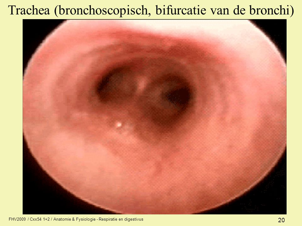 Trachea (bronchoscopisch, bifurcatie van de bronchi)