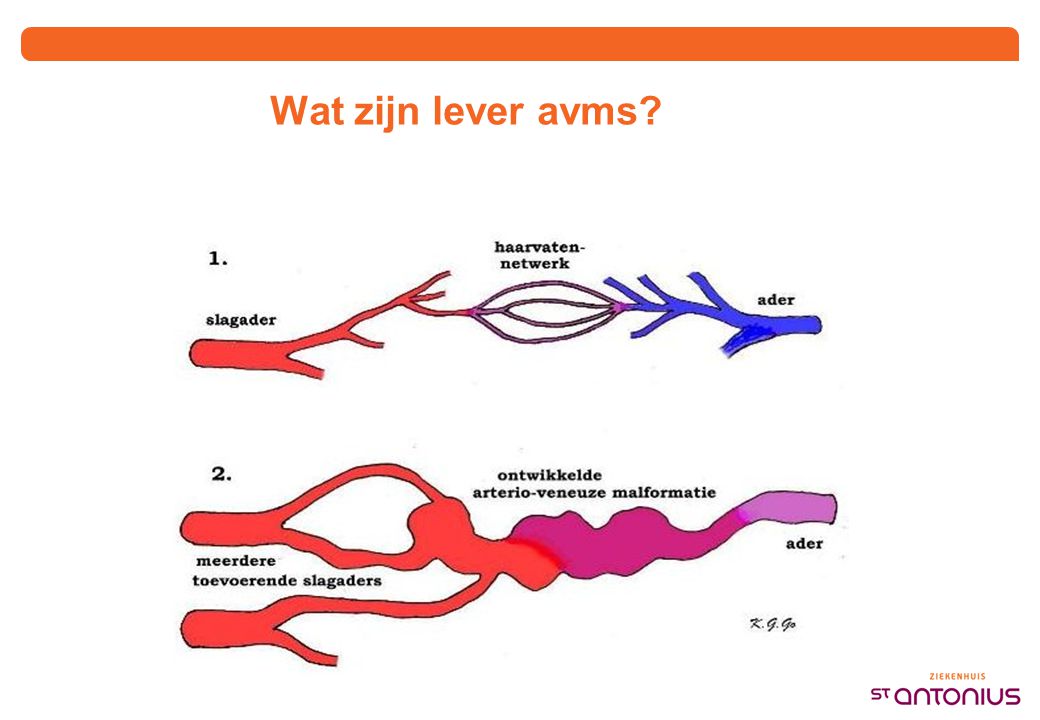 CT lever avms