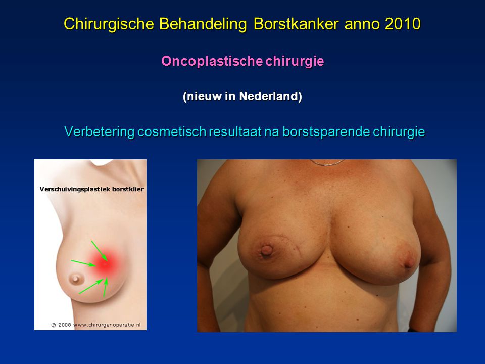 Chirurgische Behandeling Borstkanker anno 2010 Oncoplastische chirurgie (nieuw in Nederland)