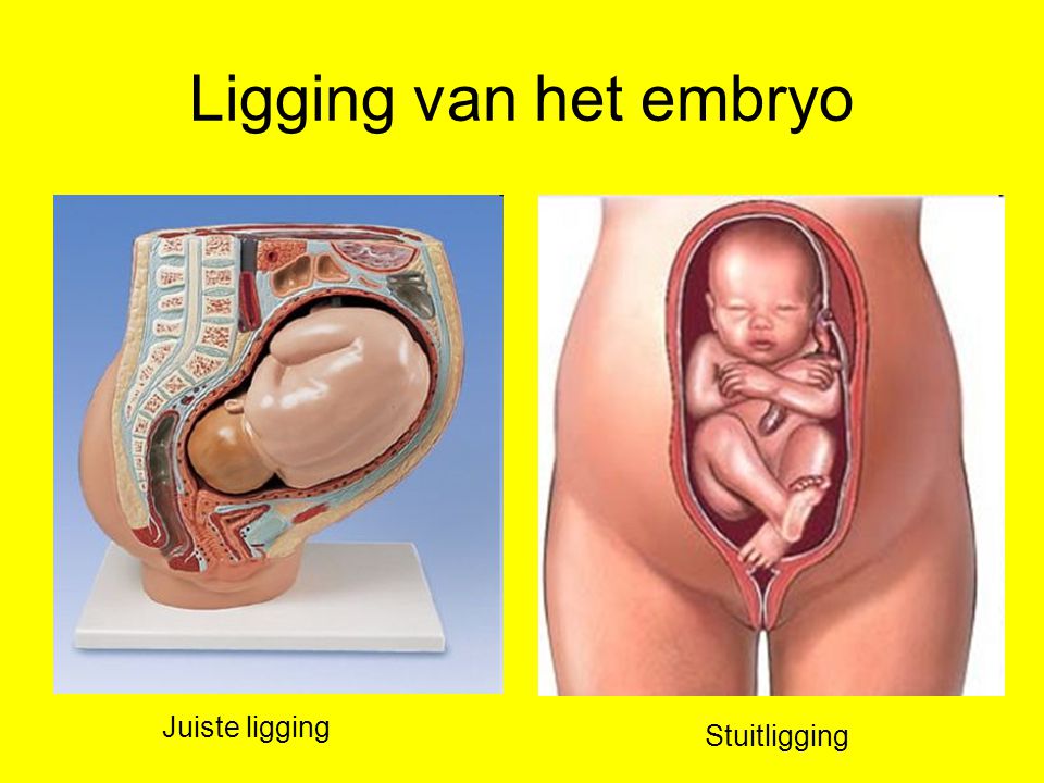 Ligging van het embryo Juiste ligging Stuitligging