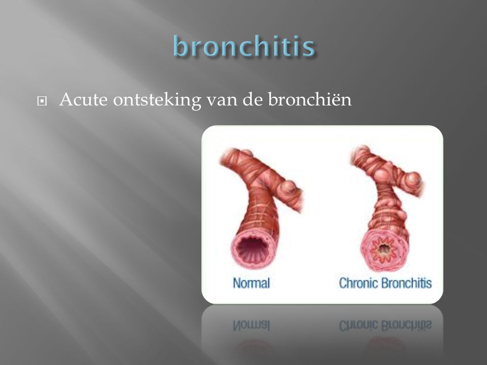bronchitis Acute ontsteking van de bronchiën