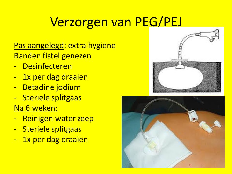 Verzorgen van PEG/PEJ Pas aangelegd: extra hygiëne