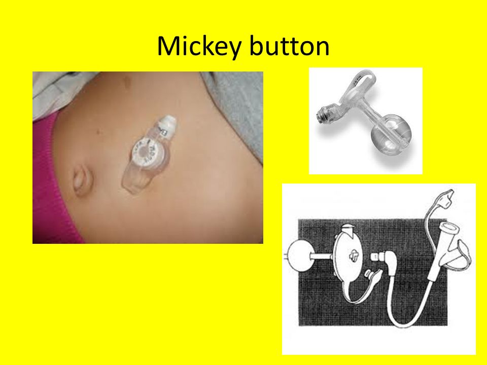 Mickey button