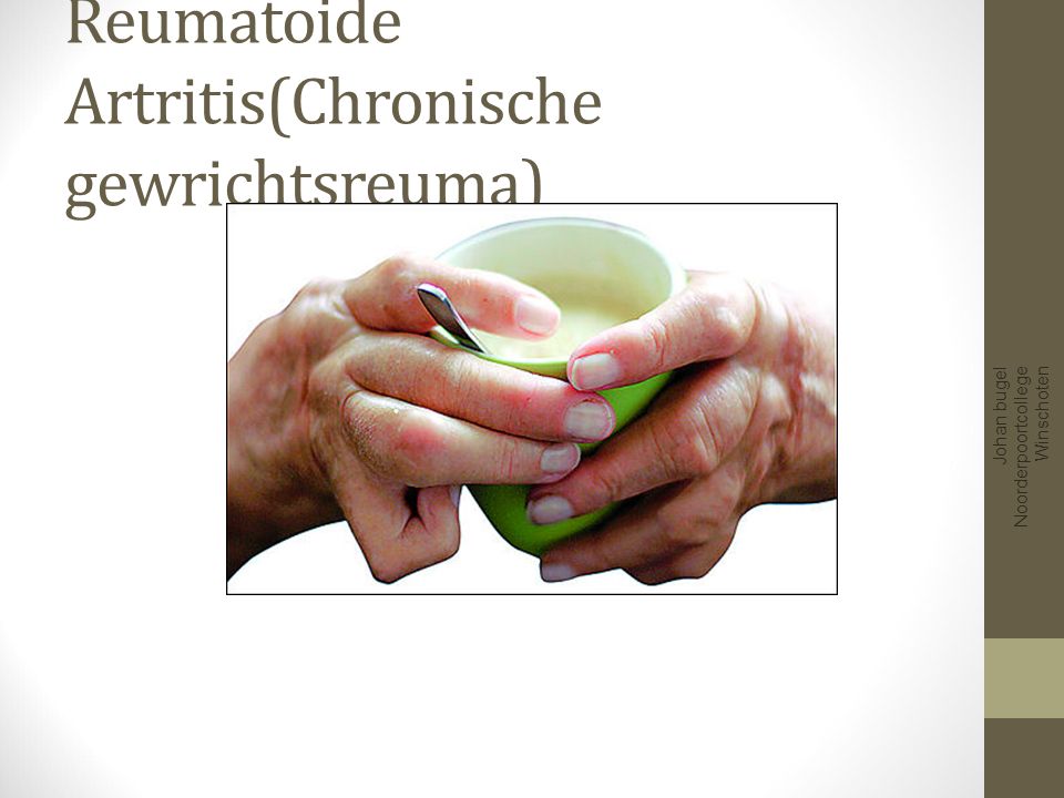 Reumatoide Artritis(Chronische gewrichtsreuma)