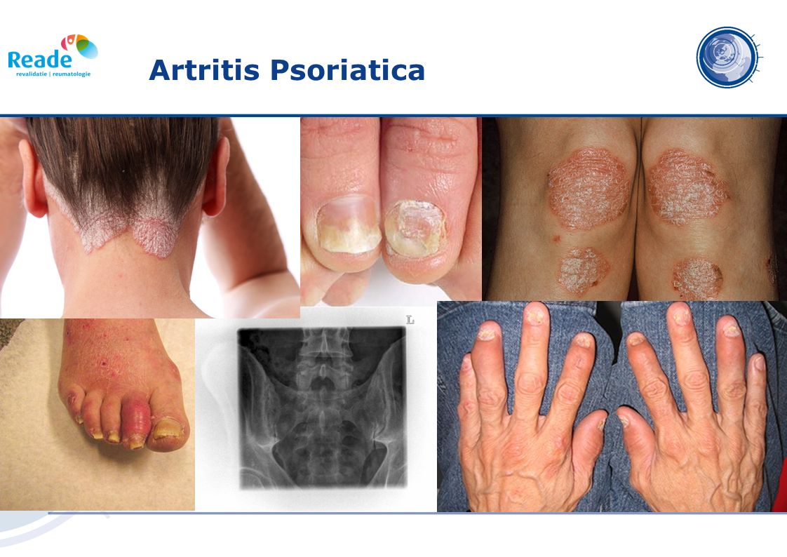 artritis psoriatica prognose)