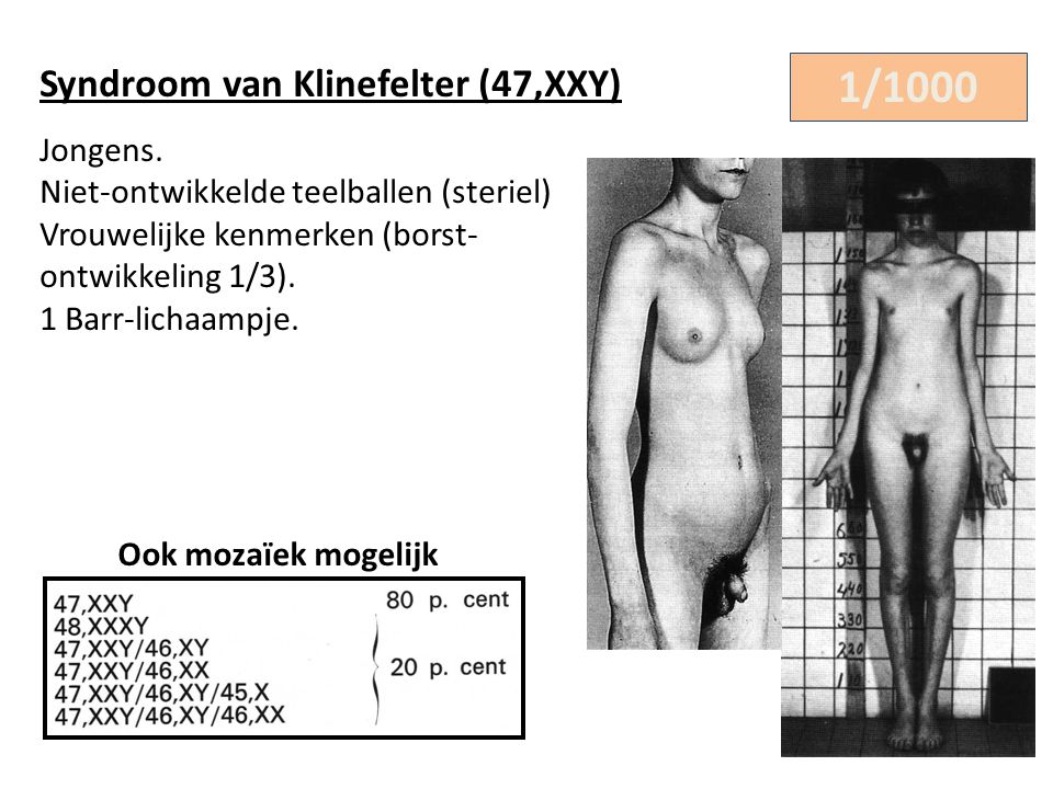 1/1000 Syndroom van Klinefelter (47,XXY)
